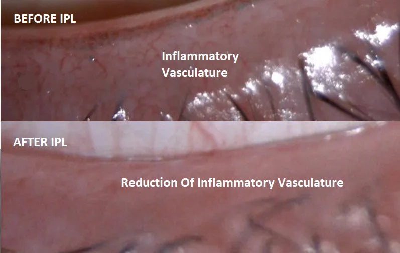 IPL Treatment for Dry Eye: A Comprehensive Approach to Alleviate Symptoms