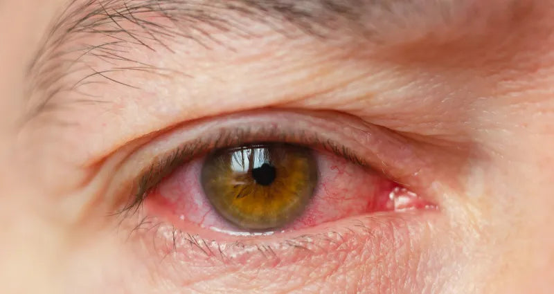 red eyes from contact lenses