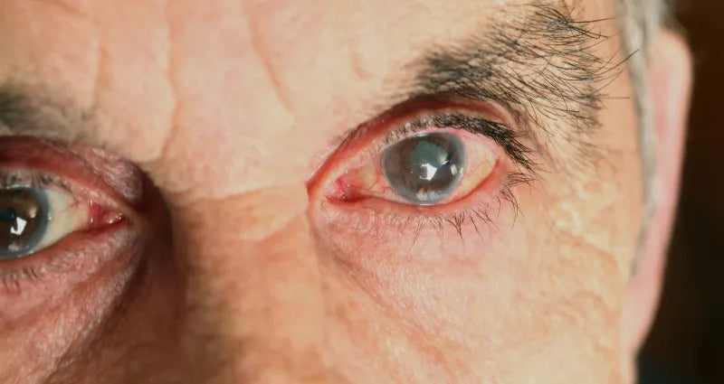 Cataract Surgery In BC